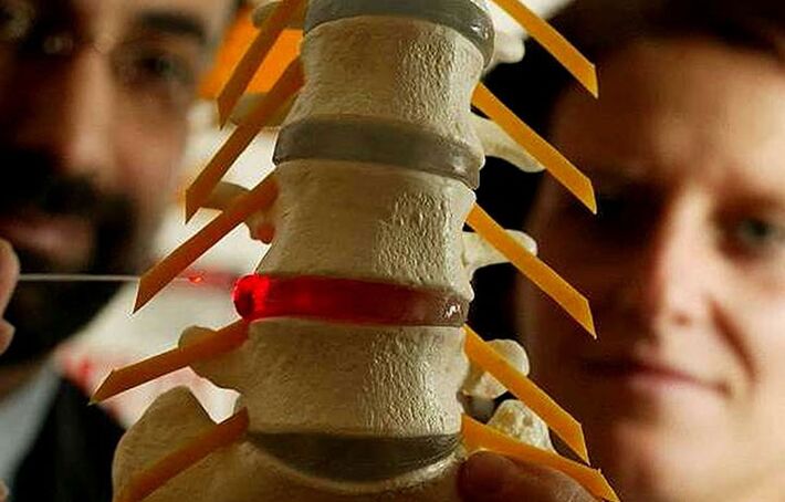 Cambios en la integridad de los discos intervertebrales