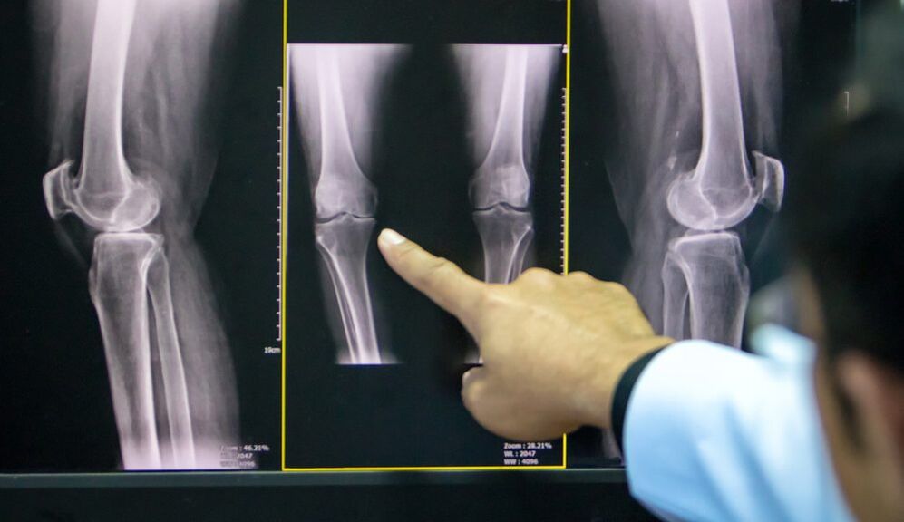 osteoartritis de la radiografía de la rodilla