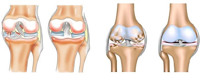 Diferencia entre artritis (izquierda) y artrosis (derecha) de las articulaciones