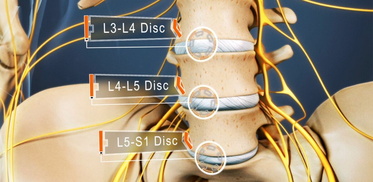Discos intervertebrales de la columna lumbar, que se ven afectados con mayor frecuencia en la osteocondrosis