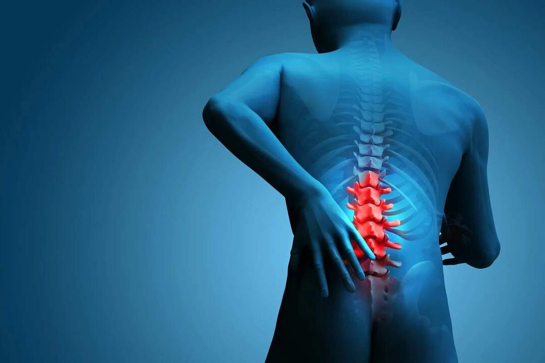 El síntoma principal de la osteocondrosis de la columna lumbar es el dolor de espalda. 