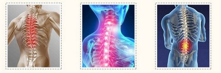 Osteocondrosis de diferentes columnas
