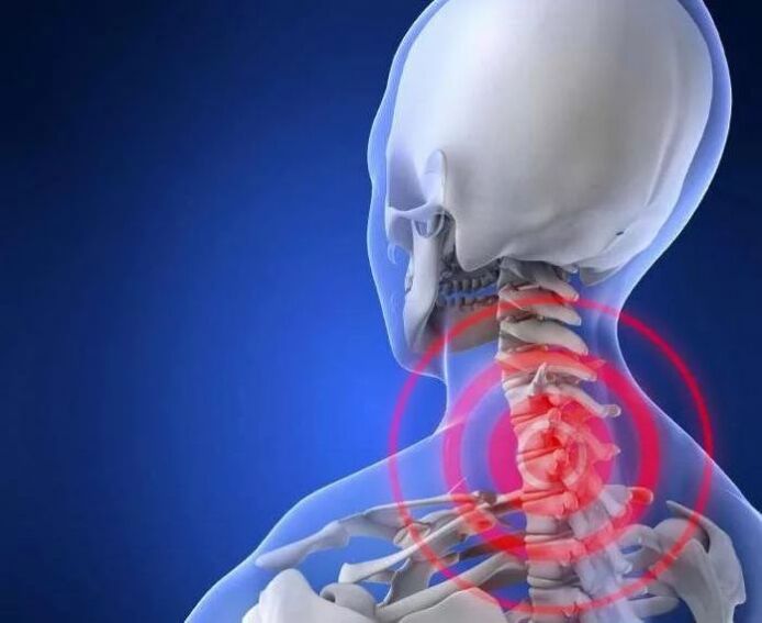 ¿Qué es la osteocondrosis