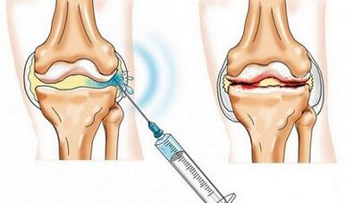 El bloqueo de la articulación de la rodilla para la osteoartritis