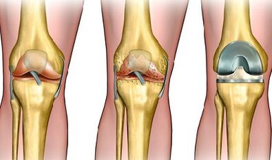 El grado de desarrollo de la artrosis de la articulación de la rodilla