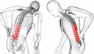 Hernia vertebral intermedia complicación con osteocondrosis