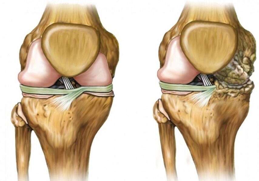 Osteoartritis de rodilla