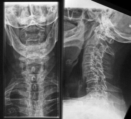 Diagnóstico de rayos x -rayos de cervical del método de osteocondrosis