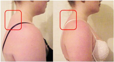 Formación de rollos musculares con osteocondrosis cervical