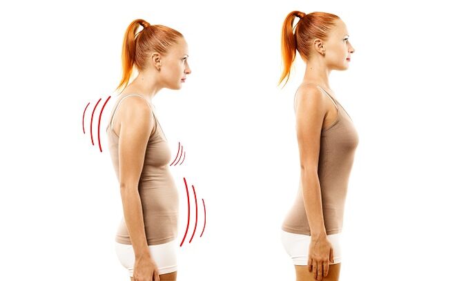 Error como la causa del desarrollo de la osteocondrosis lumbar