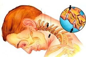 Apriete el nervio en la columna con osteocondrosis cervical