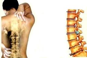 Dolor de espalda en diferentes etapas del desarrollo de la osteocondrosis cervical
