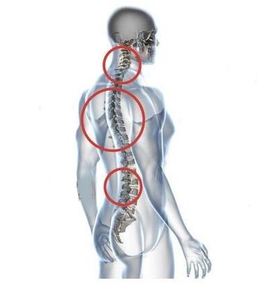 Sitios de osteocondrosis espinal.