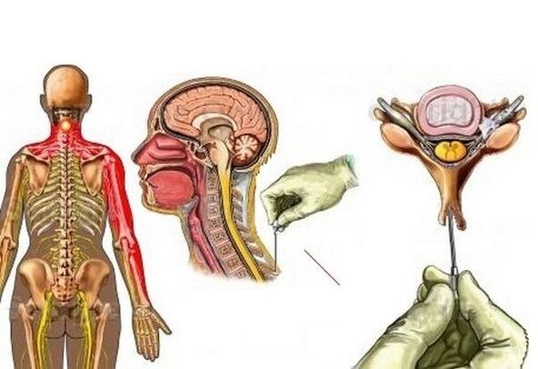 Tratamiento de la osteocondrosis cervical con acupuntura.