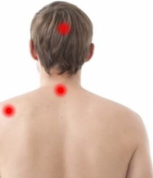 Ubicación del dolor en la osteocondrosis cervical.