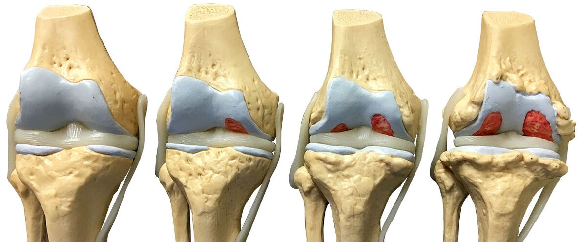 Etapas de la osteoartritis